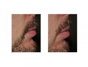 Male Upper Lip Advancement result side view