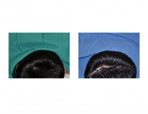 Occipital Cranioplasty in Child Dr Barry Eppley Indianapolis