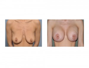 Breast Lift with Implants result front view Dr Barry Eppley Indianapolis
