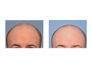CO Skull Reduction result front view