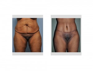 Extended Tummy Tuck results front view Dr Barry Eppley Indianapolis
