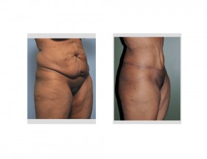 Extended TummyTuck results oblique view Dr Barry Eppley Indianapolis