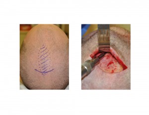 Sagittal Ridge Skull Reduction Dr Barry Eppley Indianapolis