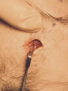 Supraorbital Nerve Graft Repair Dr Barry Eppley Indianapolis