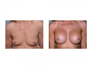 THBAM results front view