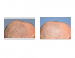 co skull reductiion result side view