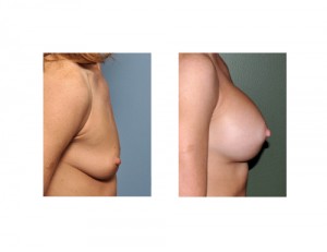 thbam results side view
