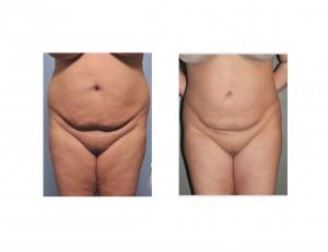 Abdominal and Flank Liposuction result Dr Barry Eppley front view