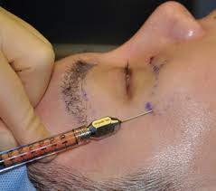Fat Injections Cheeks Dr Barry Eppley Indianapolis