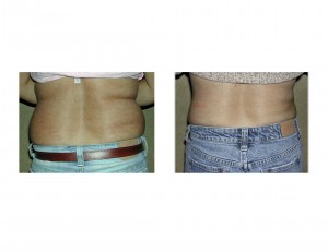 Flank Liposuction Dr Barry Eppley Indianapolis