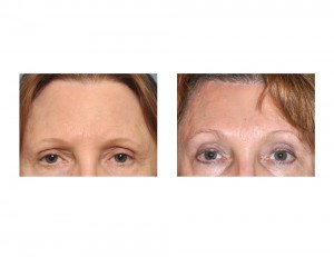JR Browlift results front view