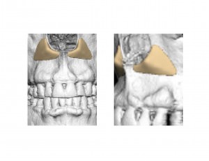 Paranasal Implant Designs Dr Barry Eppley Indianapolis