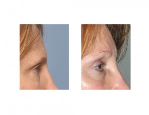 Pretrichial Browlift result side view Dr Barry Eppley Indianapolis