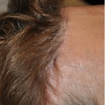 Pretrichial Hairline Scar Dr Barry Eppley Indianapolis