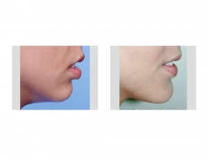 Sliding Genioplasty Chin Augmention result side view Dr Barry Eppley Indianapolis