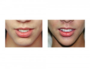 Sliding Genioplasty Chin Narrowing result front view Dr Barry Eppley Indianapolis