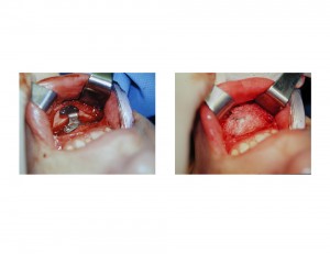Sliding Genioplasty Chin Narrowing technique Dr Barry Eppley Indianapolis
