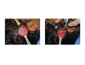 temporal muscle exposur tthickness