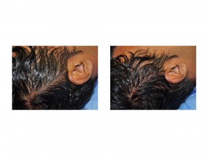 temporal muscle reduction incision