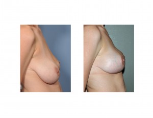 Breast Lifts Make Breast Appear Smaller Dr Barry Eppley Indianapolis