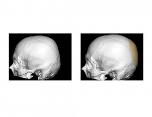 Custom Back of Head Implant design Dr Barry Eppley Indianapolis
