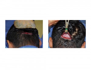 Custom Occipital Implant Placement Dr Barry Eppley Indianapolis