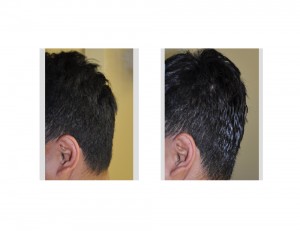 Custom Occipital Implant results side view