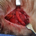 Greater Occipital Nerve Decompression Dr Barry Eppley Indianapolis
