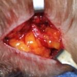 Greater Occipital Nerve Decompression with Fat Graft Dr Barry Eppley