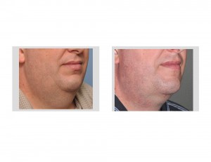 Large Neck Liposuction result oblique view