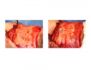 Osteoplastic Brow Bone Reduction Technique side view Dr Barry Eppley Indianapolis