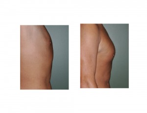 Pectoral Implants after Weight Loss Dr Barry Eppley Indianapolis