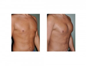 Pectoral Implants after Weight Loss result oblique view Dr Barry Eppely Indianapolis