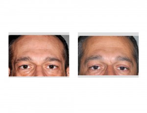 Temple Implants in Facial Lipoatrophy result front view Dr Barry Eppley Indianapolis