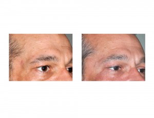 Temples Implants in Facial Lipoatrophy result oblique view Dr Barry Eppley Indianapolis