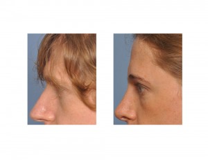 Transgender Brow Bone Reduction result side view Dr Barry Eppley Indianapolis