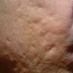acne scars