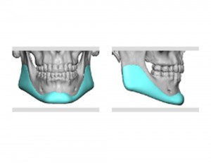 Custom Jawline Implant design Dr Barry Eppley Indianapolis