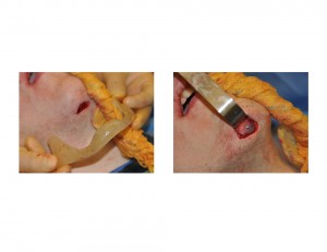 Custom Jawline Implant placement Dr Barry Eppley Indianapolis