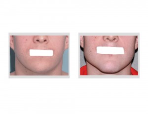 Custom Jawline Implant result front view