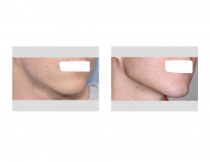 Custom Jawline Implant result oblique view