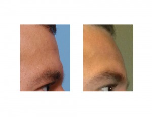 Fat Injection to Brow Bone Break Dr Barry Eppley Indianapolis