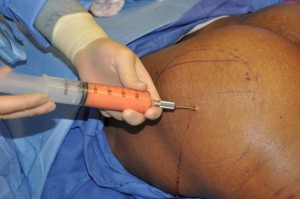 Fat Injections Buttocks Brazilian Butt Lift Dr Barry Eppley Indianapolis