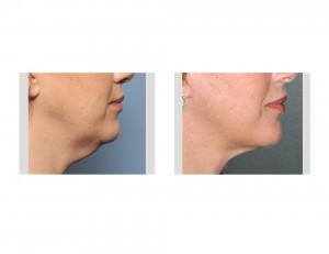 Limited Facelift result side view Dr Barry Eppley Indianapolis