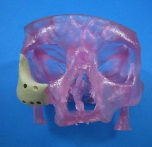 OsteoFab PEKK Facial Implants Dr Barry Eppley Indianapolis