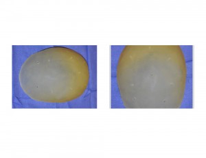 Perforated Skull Cap Implant Dr Barry Eppley Indianapolis