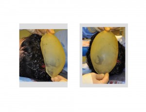 Skull Cap Implant Shape Dr Barry Eppley Indianapolis