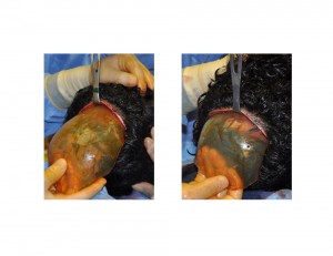 Skull Cap Implant insertion Dr Barry Eppley Indianapolis