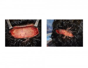 Skull Cap Implant placement Dr Barry Eppley Indianapolis