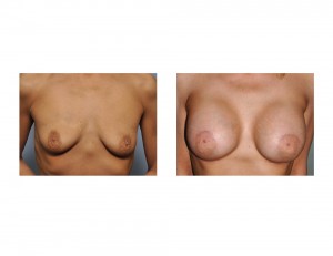 Stacey Norman Breast Augmentation results front view